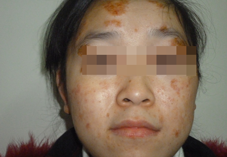 女孩湿疹严重毁容 一周治愈重现亮美皮肤