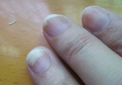 一位东莞的朋友开心地告诉我，困扰他多年的灰指甲病终于治愈