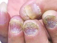 广州天河叶女士 公司白领 26岁 患有灰指甲