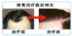 中医疗法治疗斑秃