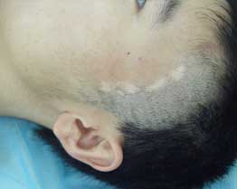 白癜风图片 白癜风图片