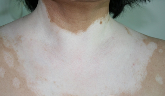 白癜风图片 白癜风图片