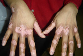 白癜风图片 白癜风图片