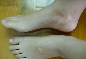 白癜风图片 白癜风图片