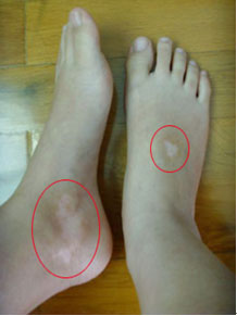 白癜风图片 白癜风图片