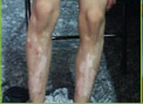 白癜风图片 白癜风图片