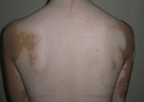 白癜风图片 白癜风图片