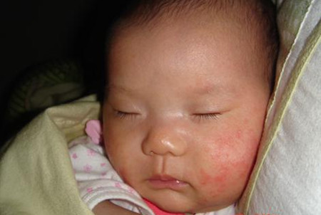 婴儿湿疹图片