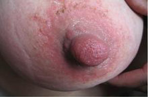 乳房湿疹图片