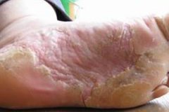 水疱型脚气有哪些临床表现