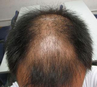 脱发是什么原因导致的