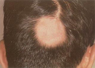 斑秃的原因及治疗