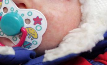 什么原因引起婴儿干性湿疹？