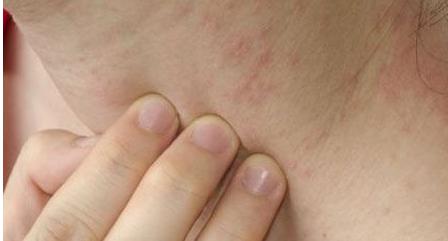 湿疹患者患病会和什么因素有关呢