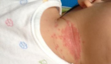 小孩子患上湿疹家长要如何去做呢